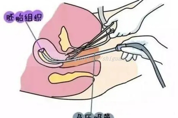 卵泡不会破是不是做试管-卵泡不破是不是只能试管