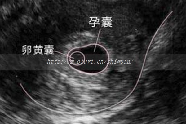 做试管月经期检查卵泡少？做试管查卵泡为啥要月经两到五天去？