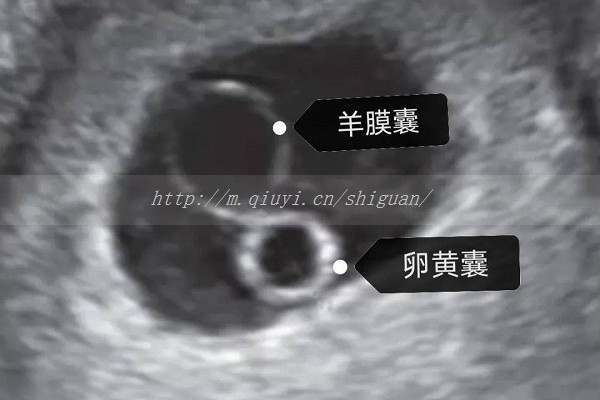 狼疮可以做试管婴儿吗？