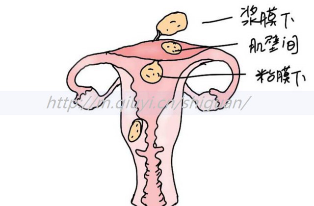 宫腔分离怎么做试管_宫腔分离会影响试管吗